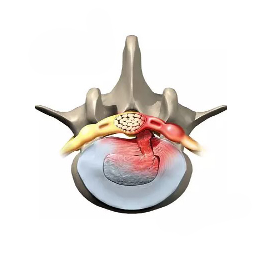 عکس دیسک کمر خفیف