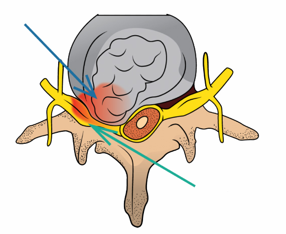 عکس دیسک کمر شدید