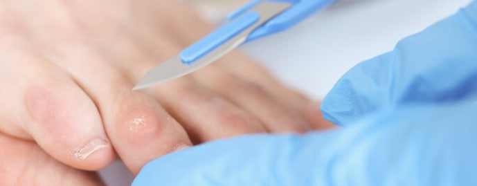 درمان فوری میخچه پا با جراحی