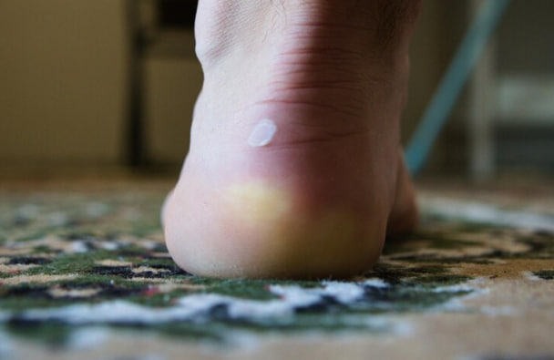 درمان فوری میخچه پا