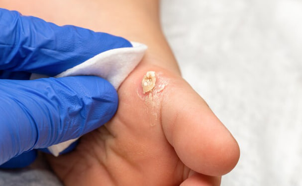 درمان میخچه با وازلین