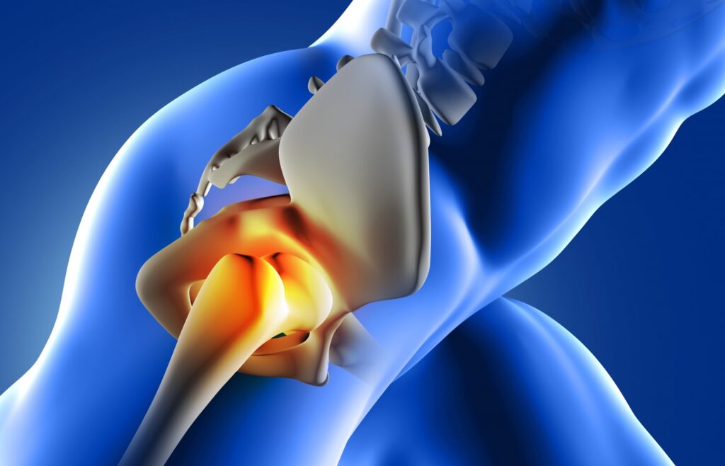 جراحی تعویض مفصل لگن