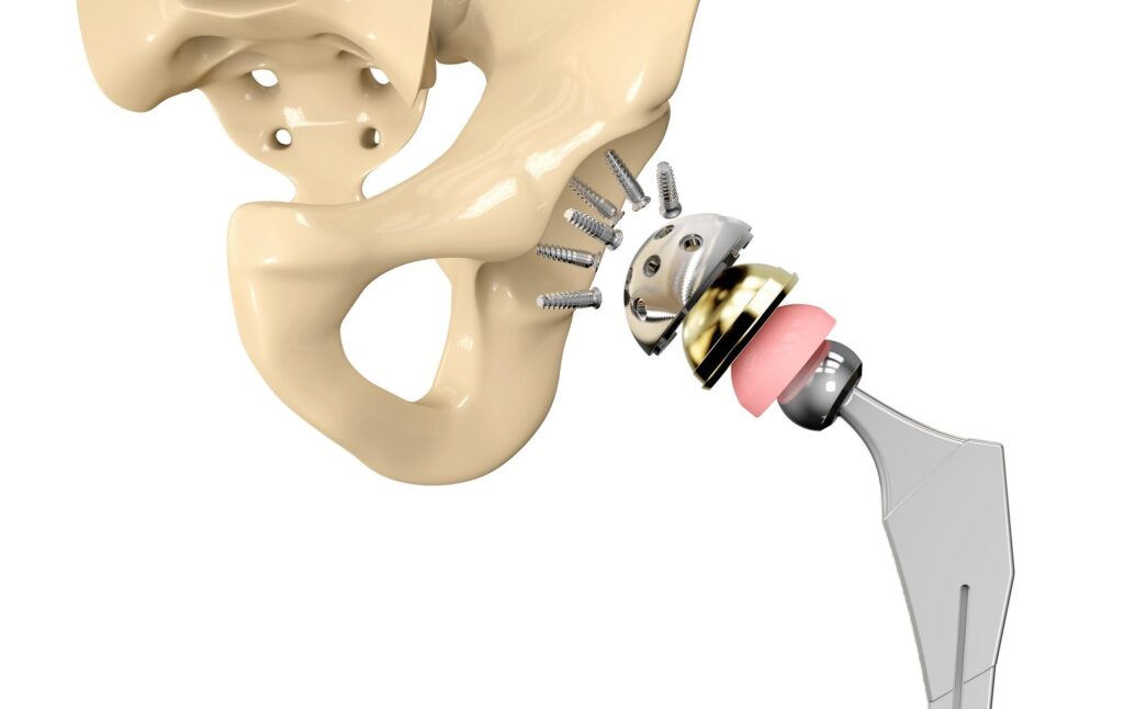 پروتز لگن چیست